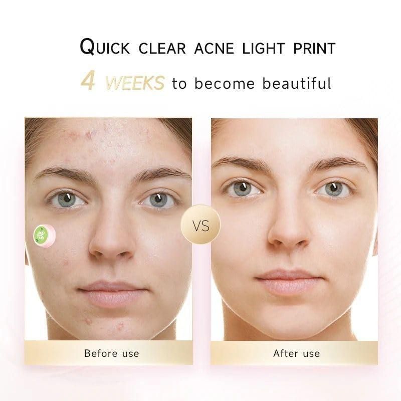 Electronic Acne Patches